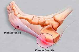 Plantarfascia fascitis