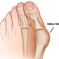 HalluxValgus