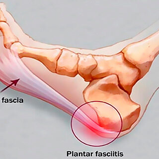Plantarfascia fascitis